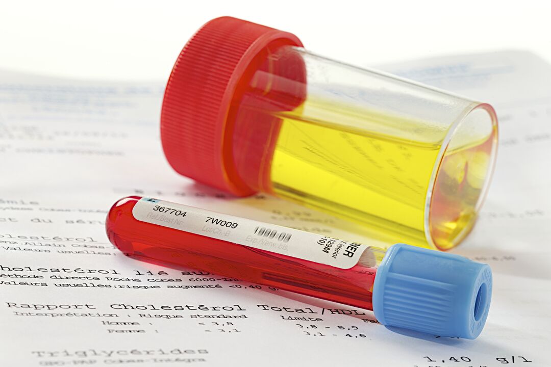 Test krvi in ​​urina bo pomagal ugotoviti prisotnost prostatitisa. 