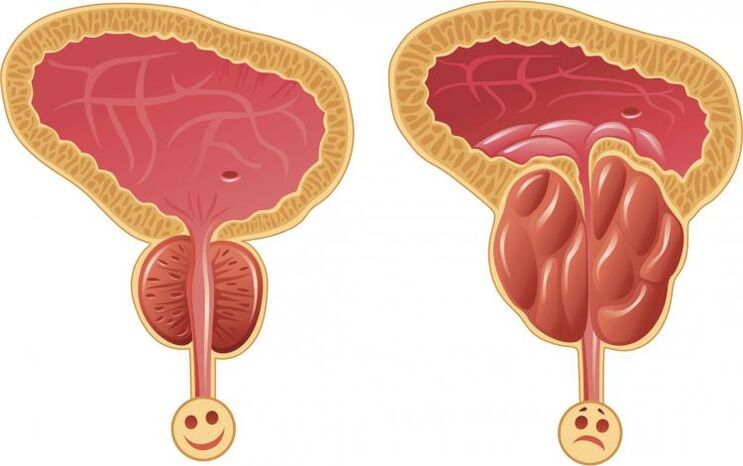 Zdrava prostata in prostatitis